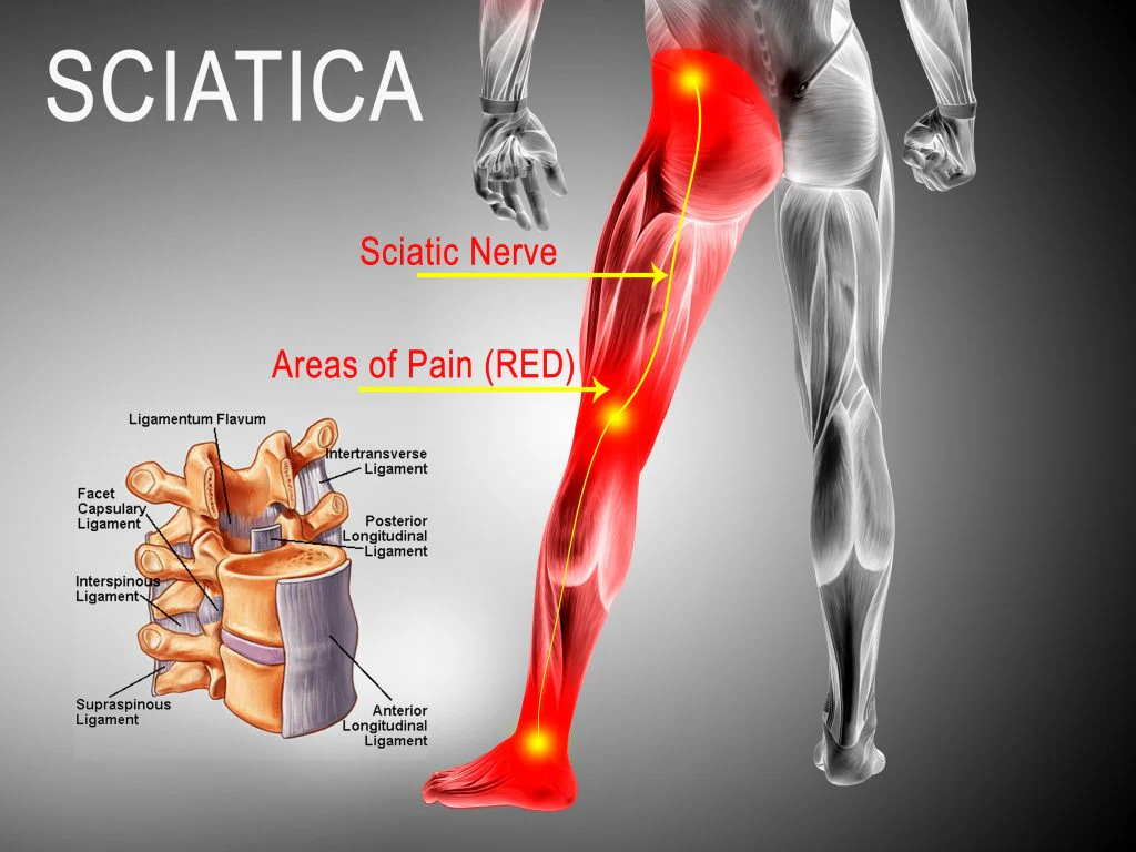 Deep Penetration & Long-Lasting Relief Natural Herbal Sciatic Nerve Orthopedic Plaster - Image 16