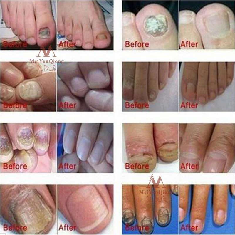 Anti-Fungal Nail & Feet Treatment Cream - Image 3