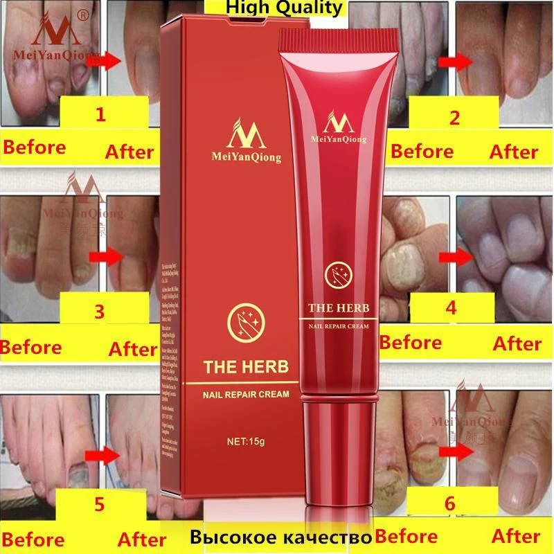 Anti-Fungal Nail & Feet Treatment Cream - Image 5