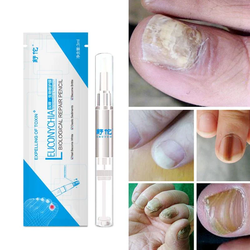 Anti-Fungal Natural Nail Treatment Pen - Image 5