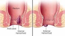 HemoRelief Cream - Image 2
