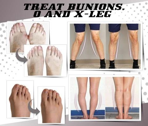 Toe Separating Bunion Corrector (2pc set) - Image 9