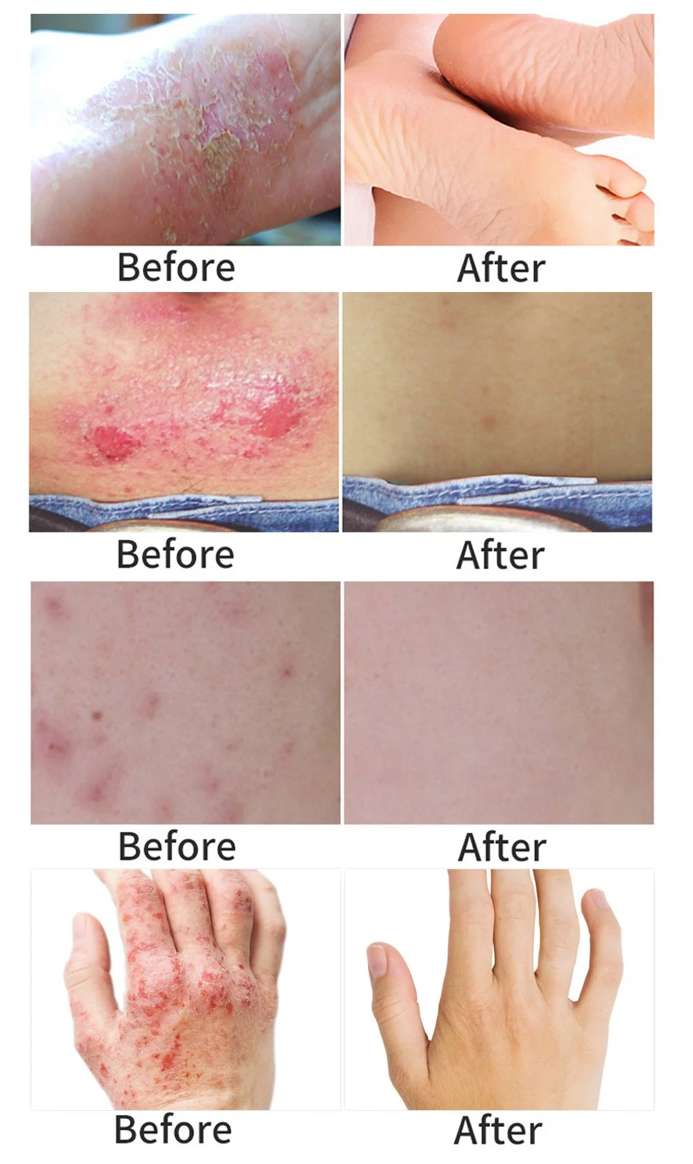 All-Natural Asian Herbal Eczema Treatment Cream - Image 5