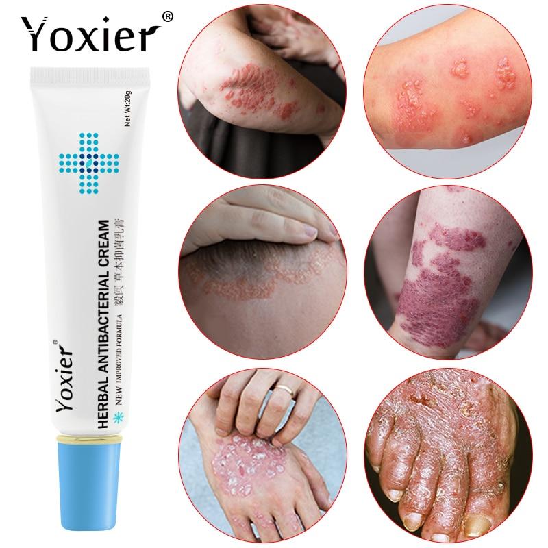 All-Natural Asian Herbal Eczema Treatment Cream - Image 7