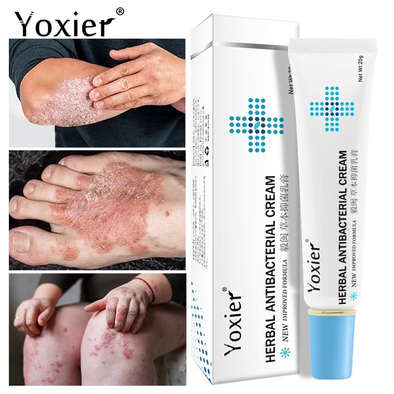 All-Natural Asian Herbal Eczema Treatment Cream - Image 8